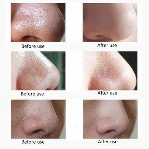 Derma Suction